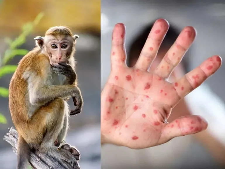 Bộ Y tế khuyến cáo 6 biện pháp phòng chống bệnh đậu mùa khỉ