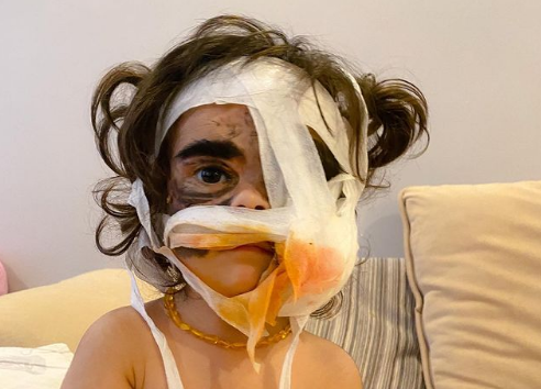 Bé gái Mỹ 2 tuổi được bác sĩ Nga phẫu thuật xóa vết bớt bẩm sinh trên mặt