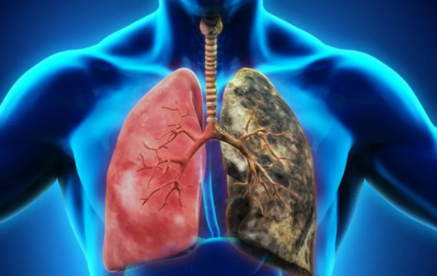 Tại sao nhiều người nghiện thuốc lá nặng vẫn không bị ung thư phổi?