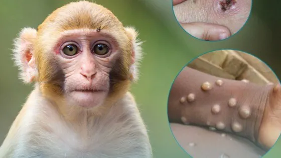 thumbnail - 6 khuyến cáo phòng chống bệnh đậu mùa khỉ, cần lưu ý ngay!