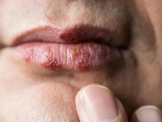 5 bệnh dễ lây khi yêu bằng miệng