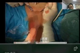 Livestream giảng dạy y khoa tại Trung Quốc lộ cả "vùng tam giác" của bệnh nhân trước 50.000 người xem