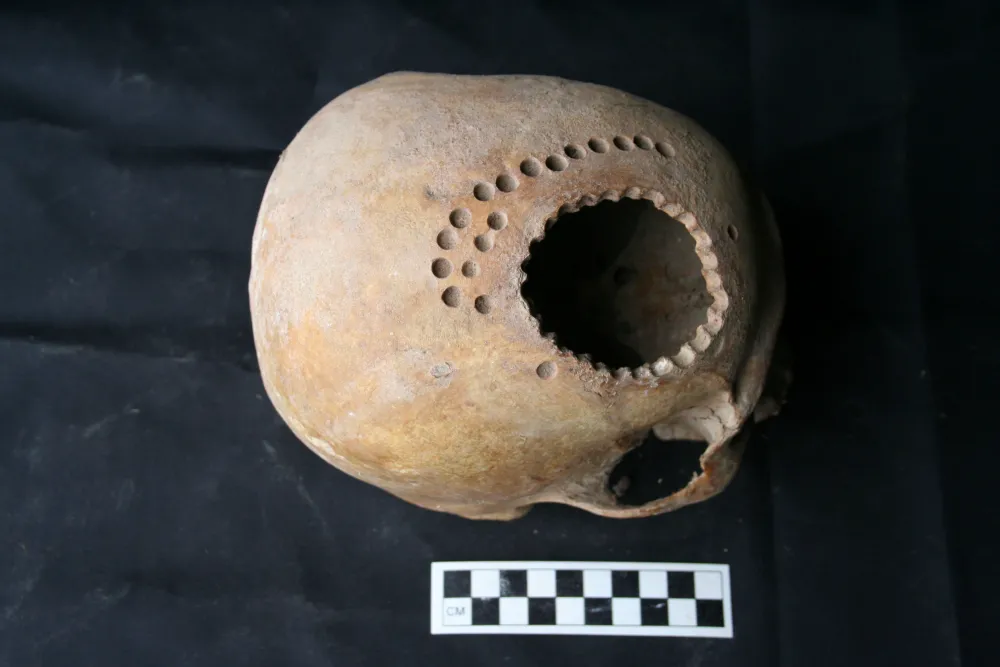thumbnail - Phẫu thuật khoan sọ có thể từng tồn tại ở thời Peru cổ đại?