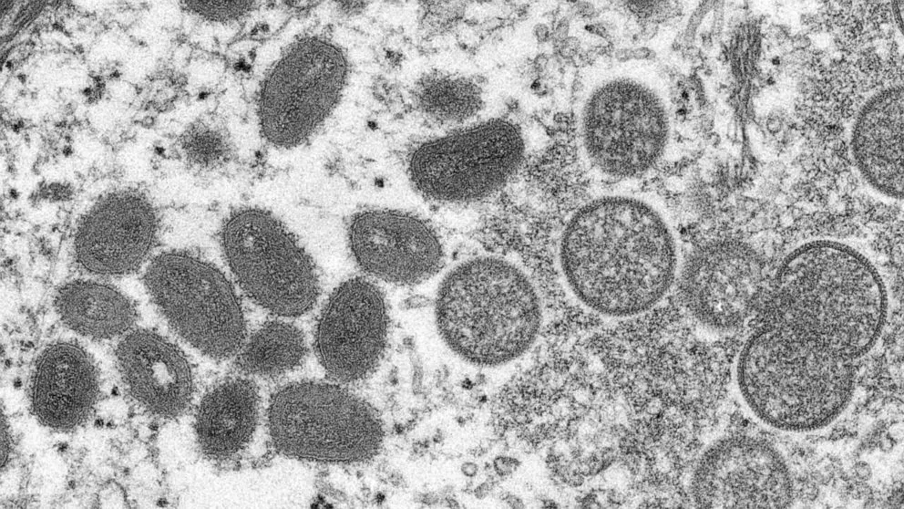 Chủng virus đậu mùa khỉ đang lây lan toàn cầu có 47 đột biến mới