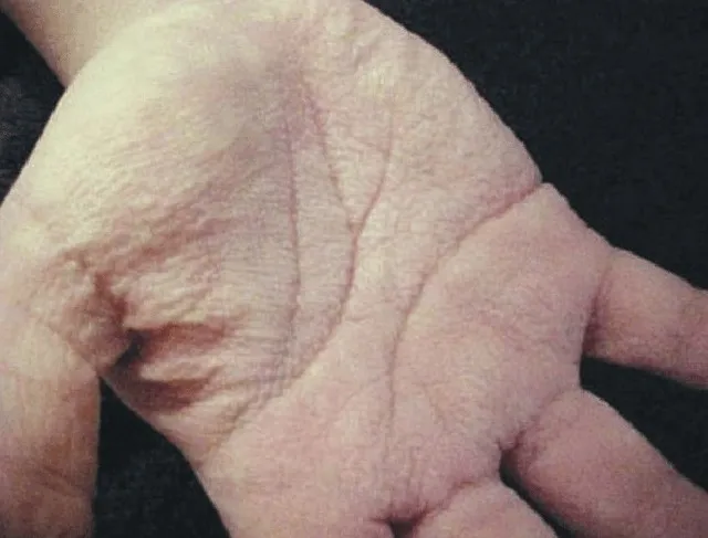 Dừng lướt TikTok và nhìn bàn tay mình: Nếu có dấu hiệu này, nhiều khả năng là ung thư