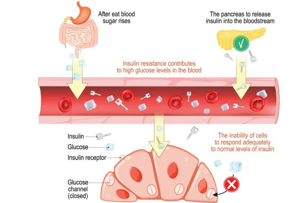 Vì sao kháng insulin lại gây nguy hiểm với sức khỏe chúng ta?