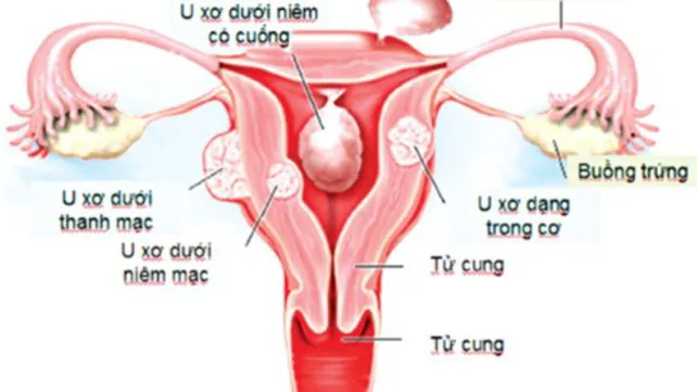 thumbnail - Thuốc điều trị u xơ tử cung gồm những gì