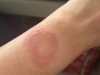 Apple Watch quá nóng khiến người dùng bị bỏng thành sẹo vĩnh viễn