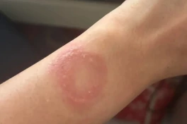 Apple Watch quá nóng khiến người dùng bị bỏng thành sẹo vĩnh viễn