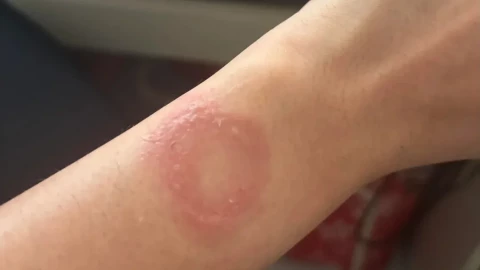 Apple Watch quá nóng khiến người dùng bị bỏng thành sẹo vĩnh viễn