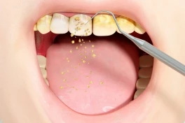 Điều gì xảy ra khi không lấy cao răng?