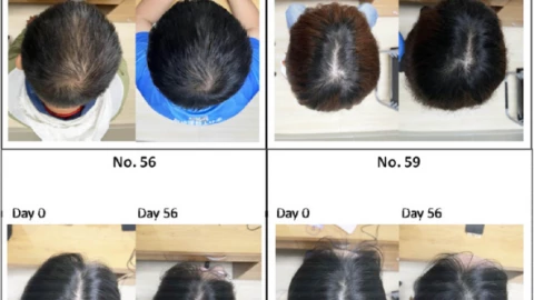 Nếu thử nghiệm này thành công, bệnh hói đầu sẽ "tuyệt chủng"