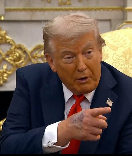 Bàn tay của Tổng thống Trump có vẻ bị bầm tím. Không rõ là gì, nhưng chắc chắn không phải