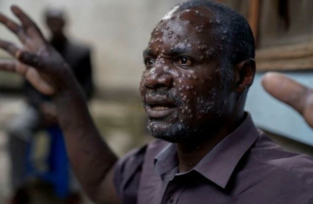mpox-17236781701021349600403_jpg_75.jpg