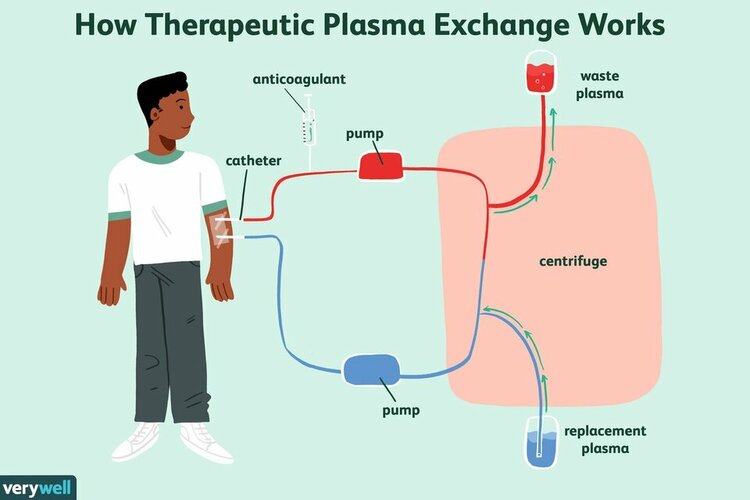 plasma-exchange-ms-treatment-2440905final-10c679e9354348a5b5a2a74555ce33b4-1738653437961704261...jpg